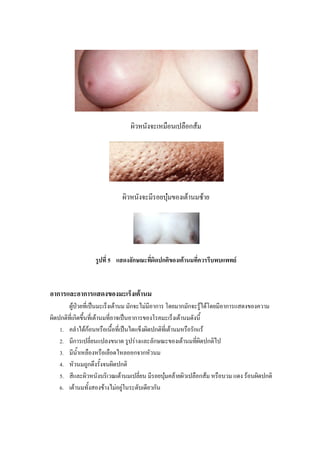 ผิวหนังจะเหมือนเปลือกสม




                            ผิวหนังจะมีรอยบุมของเตานมซาย




                  รูปที่ 5 แสดงลักษณะที่ผิดปกติของเตานมที่ควรรีบพบแพทย


อาการและอาการแสดงของมะเร็งเตานม
       ผูปวยที่เปนมะเร็งเตานม มักจะไมมอาการ โดยมากมักจะรูไดโดยมีอาการแสดงของความ
                                           ี
ผิดปกติที่เกิดขึ้นที่เตานมทีอาจเปนอาการของโรคมะเร็งเตานมดังนี้
                             ่
    1. คลําไดกอนหรือเนื้อที่เปนไตแข็งผิดปกติที่เตานมหรือรักแร

    2. มีการเปลี่ยนแปลงขนาด รูปรางและลักษณะของเตานมทีผิดปกติไป
                                                               ่
    3. มีน้ําเหลืองหรือเลือดไหลออกจากหัวนม

    4. หัวนมถูกดึงรังจนผิดปกติ
                         ้
    5. สีและผิวหนังบริเวณเตานมเปลี่ยน มีรอยบุมคลายผิวเปลือกสม หรือบวม แดง รอนผิดปกติ
                                                 
    6. เตานมทั้งสองขางไมอยูในระดับเดียวกัน
 