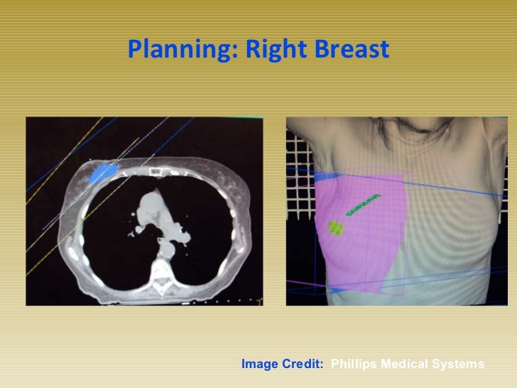 Early Stage Breast Cancer and Radiation Therapy