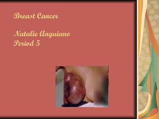 Breast Cancer Natalie Anguiano Period 5   
