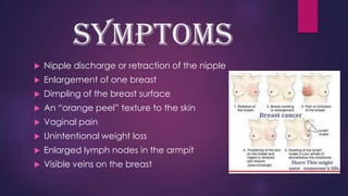 Breast cancer powerpoint | PPTX