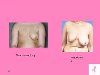 30
lumpectom
y
Total mastectomy
 