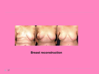 37
Breast reconstruction
 