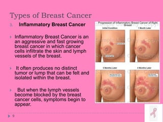 Types of Breast Cancer
9
3. Inflammatory Breast Cancer
 Inflammatory Breast Cancer is an
an aggressive and fast growing
breast cancer in which cancer
cells infiltrate the skin and lymph
vessels of the breast.
 It often produces no distinct
tumor or lump that can be felt and
isolated within the breast.
 But when the lymph vessels
become blocked by the breast
cancer cells, symptoms begin to
appear.
 