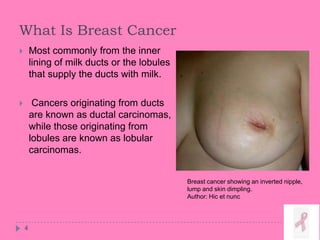 What Is Breast Cancer
 Most commonly from the inner
lining of milk ducts or the lobules
that supply the ducts with milk.
 Cancers originating from ducts
are known as ductal carcinomas,
while those originating from
lobules are known as lobular
carcinomas.
4
Breast cancer showing an inverted nipple,
lump and skin dimpling.
Author: Hic et nunc
 