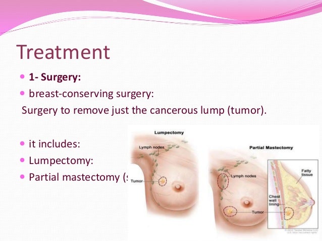What is a partial mastectomy?