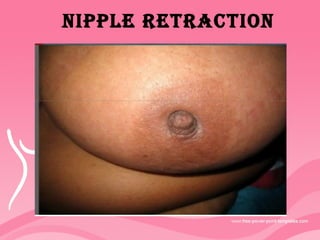 NIpplE RETRACTION
 