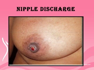 NIpplE DISCHARGE
 