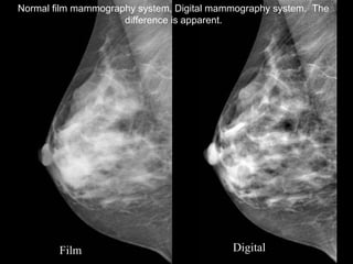 Film Digital
Normal film mammography system, Digital mammography system. The
difference is apparent.
 