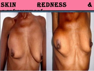 SkIN REDNESS &
ASymmETRy
 