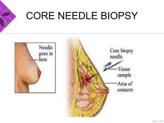 CORE NEEDLE BIOPSY
 