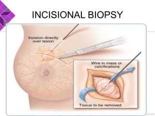 INCISIONAL BIOPSY
 