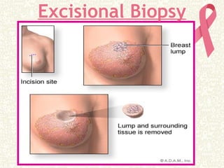 Excisional Biopsy
 