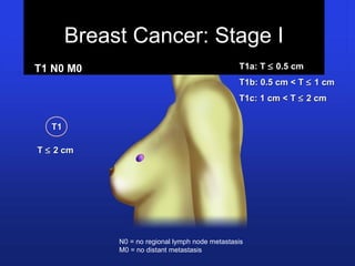 Breast Cancer: Stage I
T1a: TT1a: T ≤≤ 0.5 cm0.5 cm
T1b: 0.5 cm < TT1b: 0.5 cm < T ≤≤ 1 cm1 cm
T1c: 1 cm < TT1c: 1 cm < T ≤≤ 2 cm2 cm
T1 N0 M0T1 N0 M0
TT ≤≤ 2 cm2 cm
T1T1
N0 = no regional lymph node metastasis
M0 = no distant metastasis
 