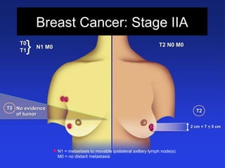 Breast Cancer: Stage IIA
T2 N0 M0T2 N0 M0
N1 = metastasis to movable ipsilateral axillary lymph node(s)
M0 = no distant metastasis
2 cm < T2 cm < T << 5 cm5 cm
No evidenceNo evidence
of tumorof tumor
T0T0
T0T0
T1T1
N1 M0N1 M0}
T2T2
 