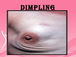 DImplING
 