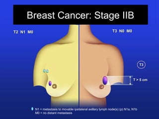 Breast Cancer: Stage IIB
T3 N0 M0T3 N0 M0
N1 = metastasis to movable ipsilateral axillary lymph node(s) (p) N1a, N1b
M0 = no distant metastasis
T > 5 cmT > 5 cm
T2 N1 M0T2 N1 M0
T3T3
 