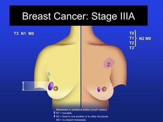 Breast Cancer: Stage IIIA
Metastasis to ipsilateral axillary lymph node(s)
N1 = movable
N2 = fixed to one another or to other structures
M0 = no distant metastasis
T3 N1 M0T3 N1 M0 T0T0
T1T1
T2T2
T3T3
N2 M0N2 M0
 