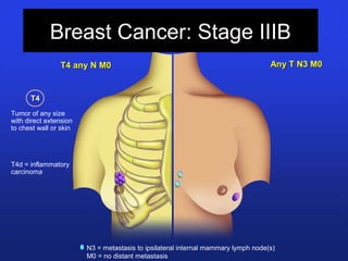 Breast Cancer: Stage IIIB
Any T N3 M0Any T N3 M0
N3 = metastasis to ipsilateral internal mammary lymph node(s)
M0 = no distant metastasis
Tumor of any size
with direct extension
to chest wall or skin
T4d = inflammatory
carcinoma
T4 any N M0T4 any N M0
T4T4
 