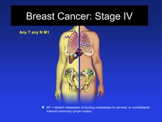 Breast Cancer: Stage IV
M1 = distant metastasis (including metastases to cervical, or contralateral
internal mammary lymph nodes)
Any T any N M1
 