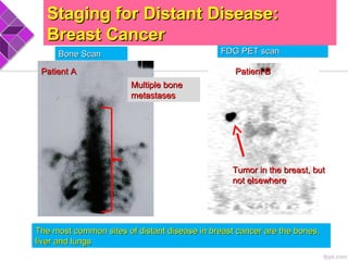 FDG PET scanFDG PET scanBone ScanBone Scan
Staging for Distant Disease:Staging for Distant Disease:
Breast CancerBreast Cancer
Tumor in the breast, butTumor in the breast, but
not elsewherenot elsewhere
Multiple boneMultiple bone
metastasesmetastases
Patient APatient A Patient BPatient B
The most common sites of distant disease in breast cancer are the bones,The most common sites of distant disease in breast cancer are the bones,
liver and lungsliver and lungs
 