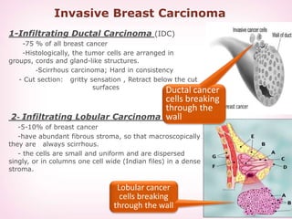Invasive Breast Carcinoma
1-Infiltrating Ductal Carcinoma (IDC)
-75 % of all breast cancer
-Histologically, the tumor cells are arranged in
groups, cords and gland-like structures.
Scirrhous carcinoma; Hard in consistency-
- Cut section: gritty sensation , Retract below the cut
surfaces
2- Infiltrating Lobular Carcinoma
-5-10% of breast cancer
-have abundant fibrous stroma, so that macroscopically
they are always scirrhous.
- the cells are small and uniform and are dispersed
singly, or in columns one cell wide (Indian files) in a dense
stroma.
Lobular cancer
cells breaking
through the wall
Ductal cancer
cells breaking
through the
wall
 