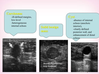 Carcinoma
-ill-defined margins,
low-level
-heterogeneous
internal echoes
Solid benign
mass
Cyst
-absence of internal
echoes (anechoic
interior),
-clearly defined
posterior wall, and
enhancement of distal
echoes
 