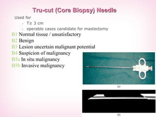 Used for
• T≥ 3 cm
• operable cases candidate for mastectomy
Tru-cut (Core Biopsy) Needle
B1 Normal tissue / unsatisfactory
B2 Benign
B3 Lesion uncertain malignant potential
B4 Suspicion of malignancy
B5a In situ malignancy
B5b Invasive malignancy
 