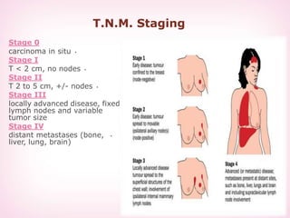 T.N.M. Staging
Stage 0
•carcinoma in situ
Stage I
•T < 2 cm, no nodes
Stage II
•T 2 to 5 cm, +/- nodes
Stage III
•locally advanced disease, fixed
lymph nodes and variable
tumor size
Stage IV
•distant metastases (bone,
liver, lung, brain)
 