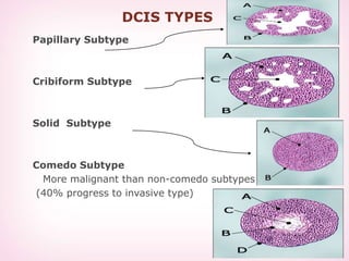 DCIS TYPES
Papillary Subtype
Cribiform Subtype
Solid Subtype
Comedo Subtype
More malignant than non-comedo subtypes
(40% progress to invasive type)
 