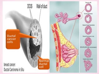 Ductal
cancer
cells
Normal
ductal
cell
 