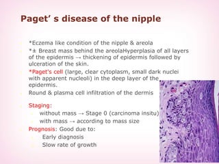 Paget’ s disease of the nipple
 *Eczema like condition of the nipple & areola
 *± Breast mass behind the areolaHyperplasia of all layers
of the epidermis → thickening of epidermis followed by
ulceration of the skin.
 *Paget's cell (large, clear cytoplasm, small dark nuclei
with apparent nucleoli) in the deep layer of the
epidermis.
 Round & plasma cell infiltration of the dermis
 Staging:
 without mass → Stage 0 (carcinoma insitu)
 with mass → according to mass size
 Prognosis: Good due to:
1. Early diagnosis
2. Slow rate of growth
 