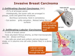 Invasive Breast Carcinoma
1-Infiltrating Ductal Carcinoma (IDC)
-75 % of all breast cancer
-Histologically, the tumor cell...