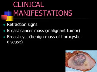 CLINICAL
MANIFESTATIONS
Retraction signs
Breast cancer mass (malignant tumor)
Breast cyst (benign mass of fibrocystic
disease)
 
