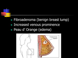 Fibroadenoma (benign breast lump)
Increased venous prominence
Peau d’ Orange (edema)
 