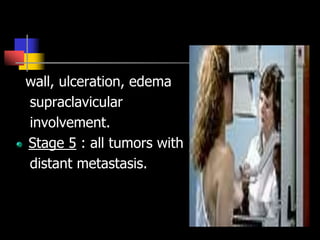 wall, ulceration, edema
supraclavicular
involvement.
Stage 5 : all tumors with
distant metastasis.
 