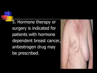 5. Hormone therapy or
surgery is indicated for
patients with hormone
dependent breast cancer,
antiestrogen drug may
be prescribed.
 