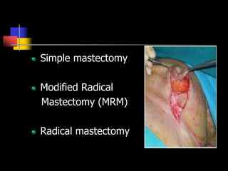 Simple mastectomy
Modified Radical
Mastectomy (MRM)
Radical mastectomy
 