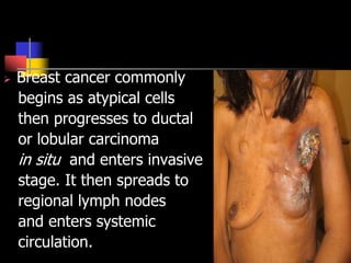  Breast cancer commonly
begins as atypical cells
then progresses to ductal
or lobular carcinoma
in situ and enters invasive
stage. It then spreads to
regional lymph nodes
and enters systemic
circulation.
 