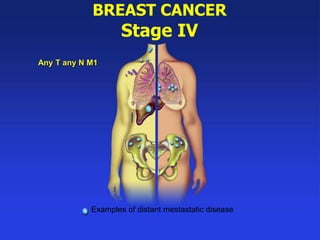 BREAST CANCER
Stage IV
Any T any N M1
Examples of distant mestastatic disease
 
