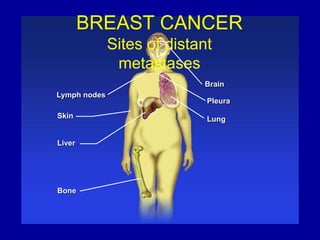 BREAST CANCER
Sites of distant
metastases
Skin
Liver
Bone
Pleura
Lung
Lymph nodes
Brain
 