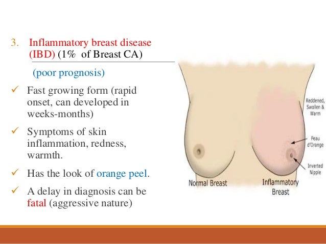 Breast Cancer