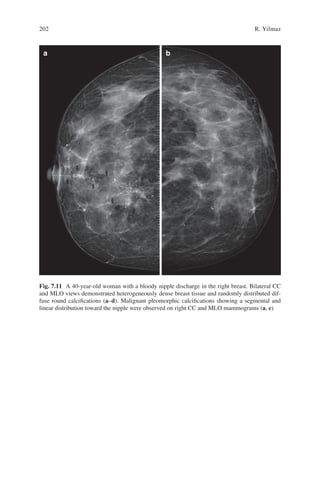 Breast Cancer_ A Guide to Clinical Practice ( PDFDrive ).pdf