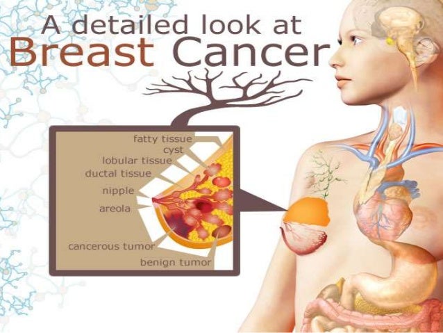 presentation of breast cancer Eposters five-year local recurrence for breast cancer; the.