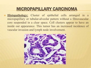 MICROPAPILLARY CARCINOMA
 Histopathology: Cluster of epithelial cells arranged in a
micropapillary or tubular-alveolar pattern without a fibrovascular
core suspended in a clear space. Cell clusters appear to have an
inside out appearance. This tumor has an increased incidence of
vascular invasion and lymph node involvement.
 