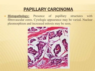 PAPILLARY CARCINOMA
 Histopathology: Presence of papillary structures with
fibrovascular cores. Cytologic appearance may be varied. Nuclear
pleomorphism and increased mitosis may be seen.
 