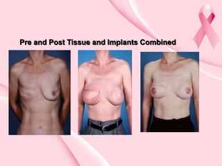Pre and Post Tissue and Implants Combined
 