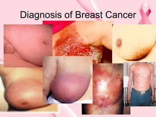 Diagnosis of Breast Cancer
 