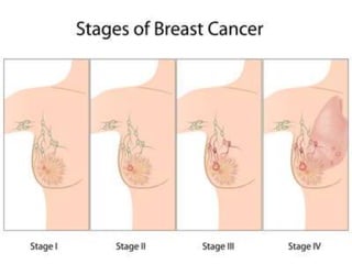 Breast cancer presentation