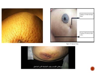 Preast Cancer Comprehensive Overview of Breast Cancer: Anatomy, Types, Diagnosis, and ...