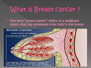    The term ―breast cancer‖ refers to a malignant
    tumor that has developed from cells in the breast.
 